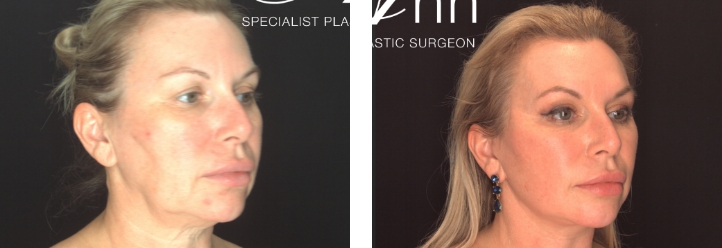 Facelift surgery before and after 18 @2x, angle view, Dr Anh Nguyen Perth