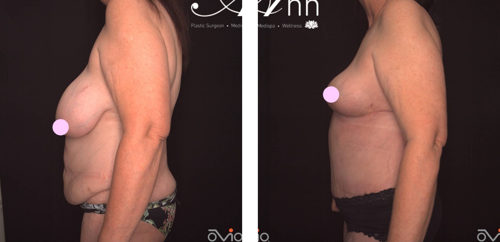 Breast reduction and abdominoplasty, before and after 2 @2x, side view, Dr Anh Perth