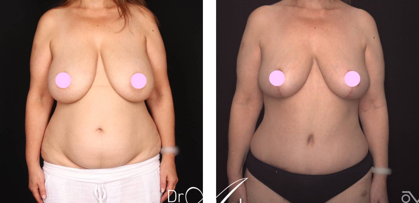 Reduction mammoplasty and abdominoplasty, before and after 3 @2x, front, Dr Anh Perth