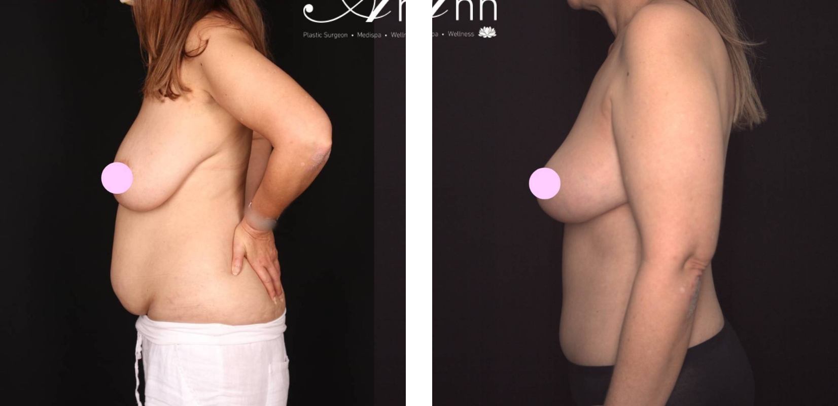 Reduction Mammoplasty and Abdominoplasty surgery, before and after 3 @2x, side view, Dr Anh