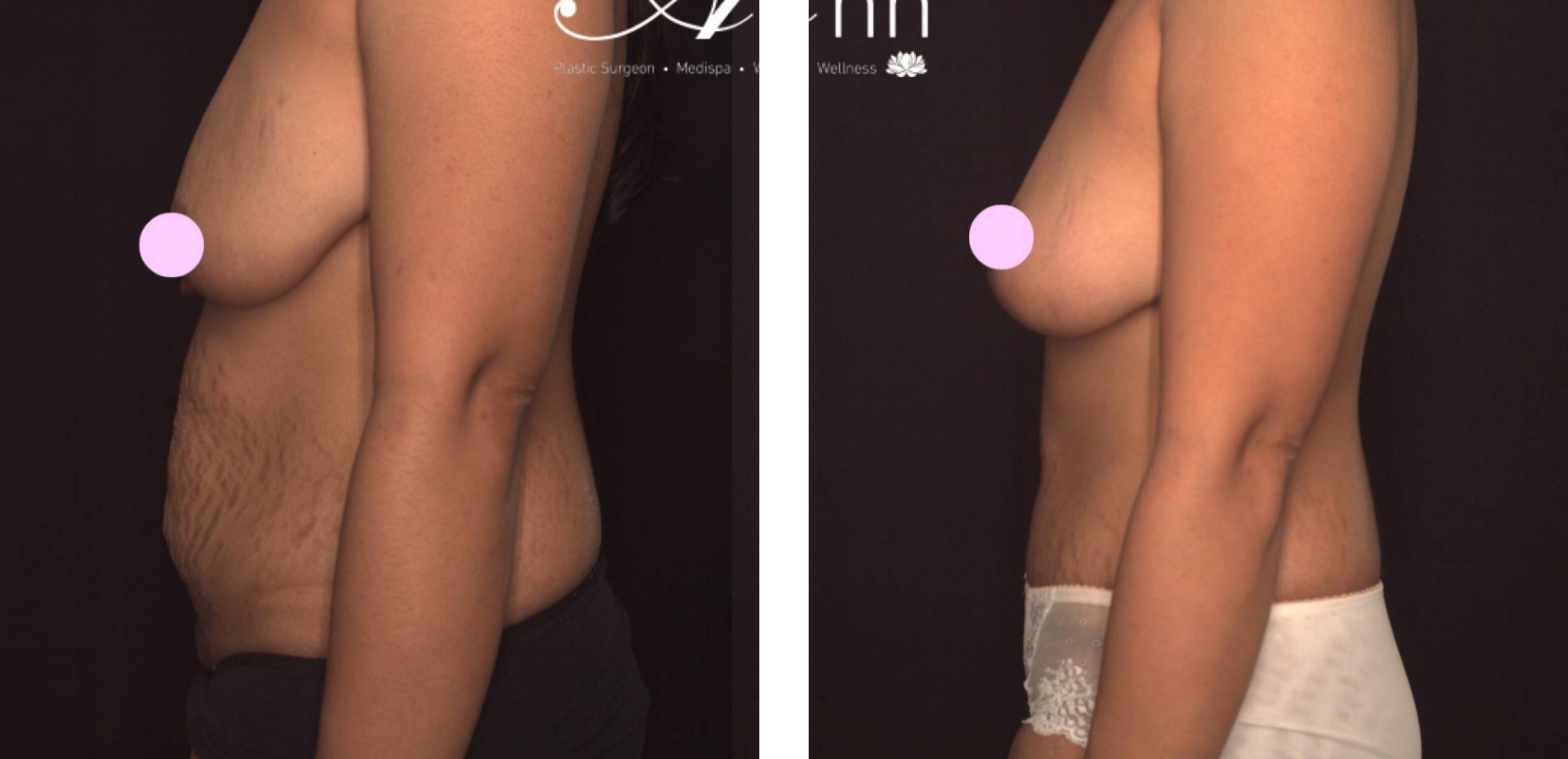 Abdominoplasty and breast reduction, before and after 4 @2x, side view, Dr Anh