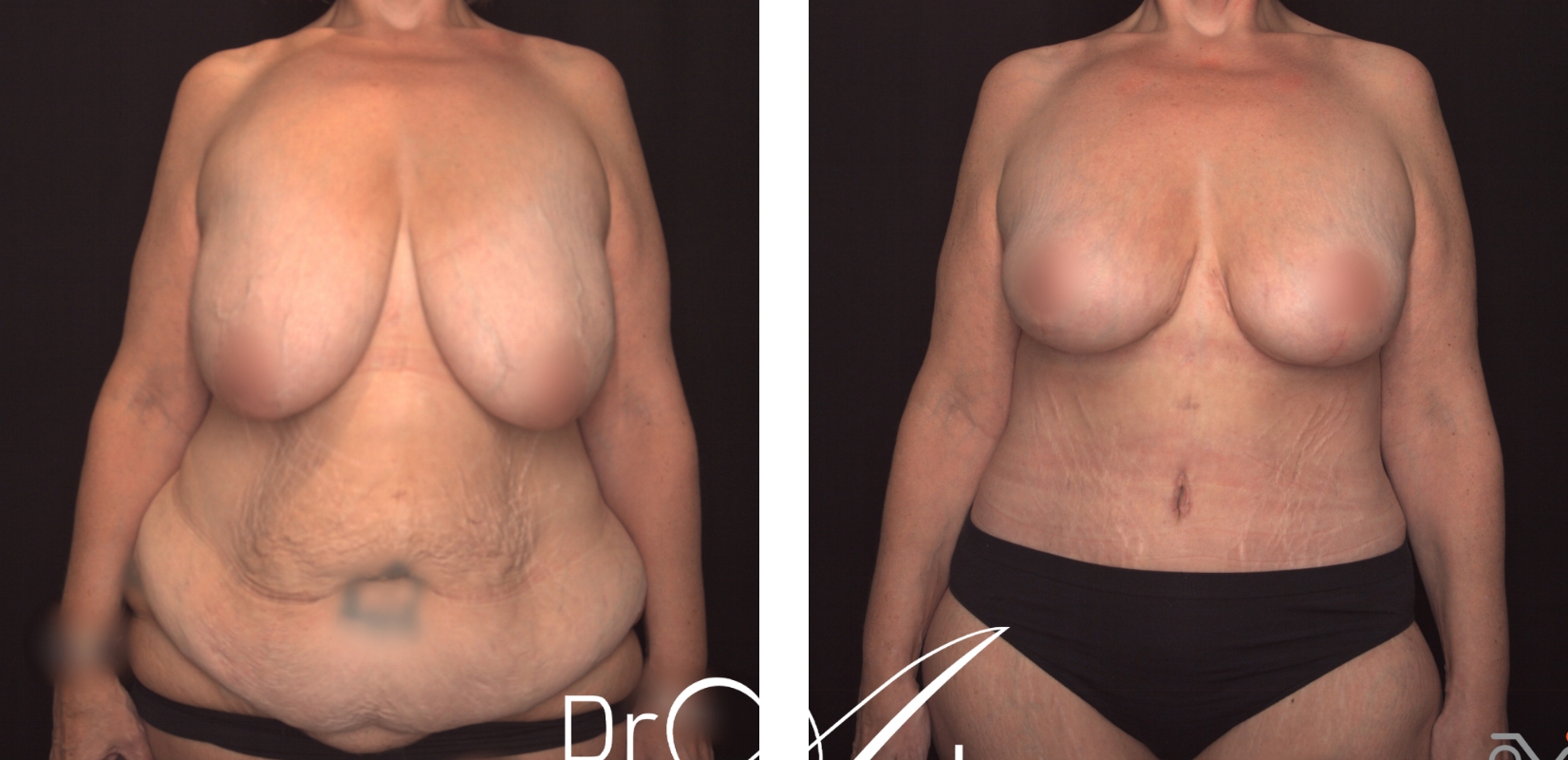 Reduction Mammoplasty and abdominoplasty, before and after 5 @2x, Dr Anh Perth