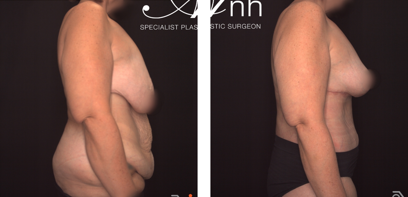 Reduction Mammoplasty and Abdominoplasty, before and after 5 @2x, side view, Dr Anh Perth