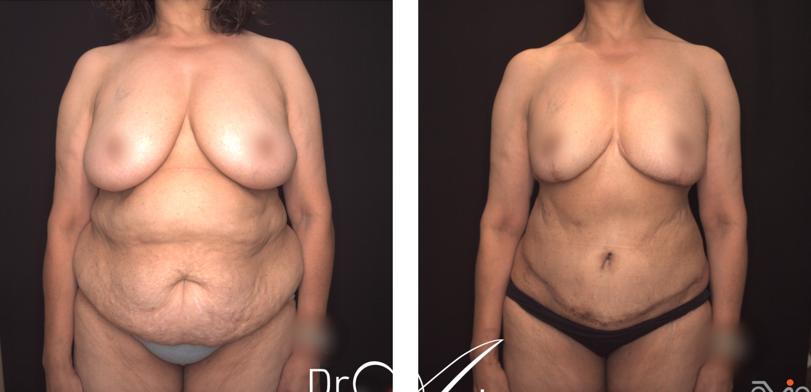 Breast reduction surgery and abdominoplasty, before and after 6 @2x, front view, Dr Anh