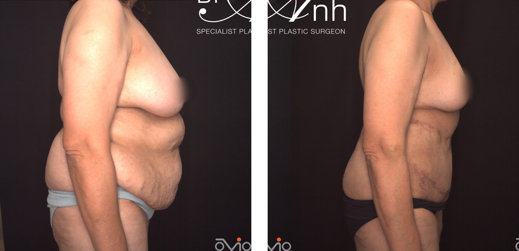 Breast reduction and abdominoplasty, before and after 6 @2x, side view, Female Plastic Surgeon Dr Anh