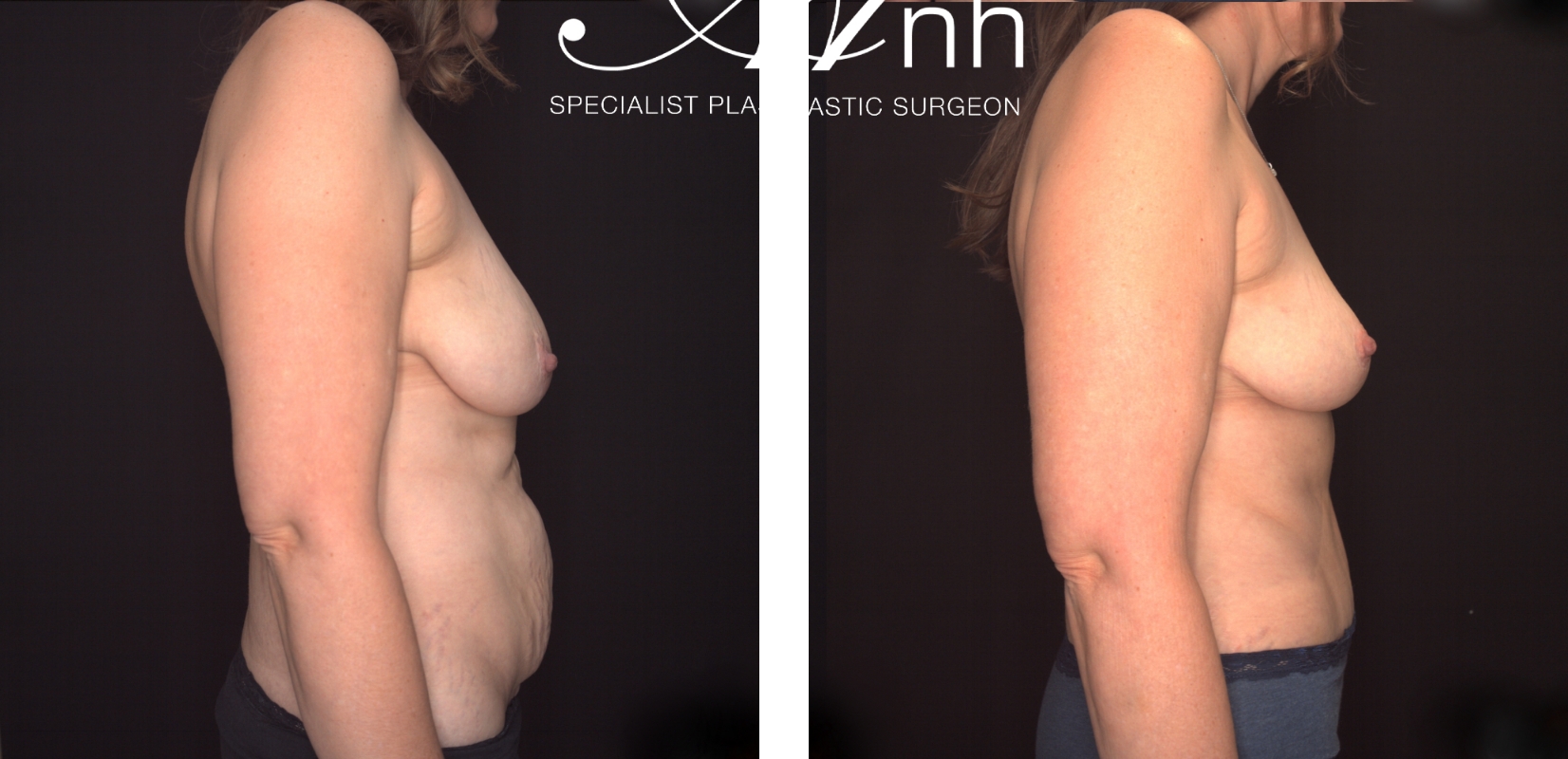 Breast reduction and abdominoplasty, before and after 7 @2x, side view, Dr Anh